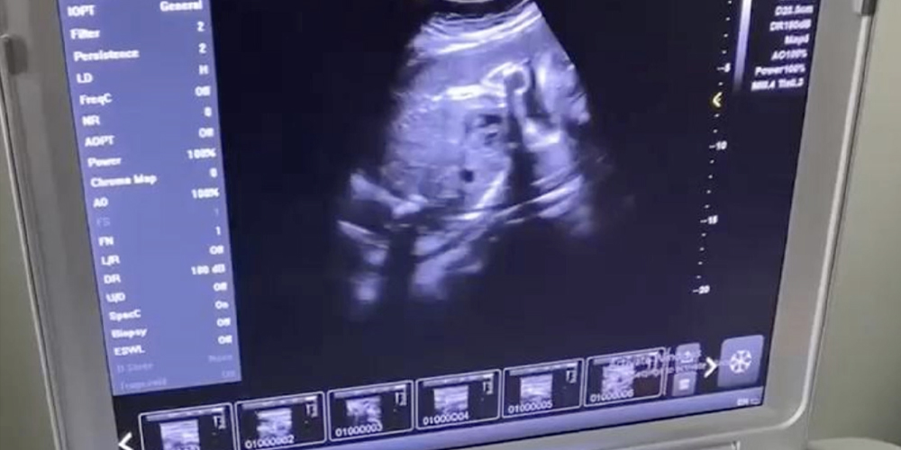 Dw-L3 កុំព្យូទ័រអ៊ុលត្រាសោនម៉ាស៊ីន-រូបភាពទារក